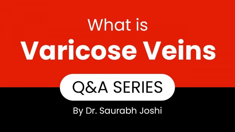 Q&A Series Episode 1 What is Varicose Veins