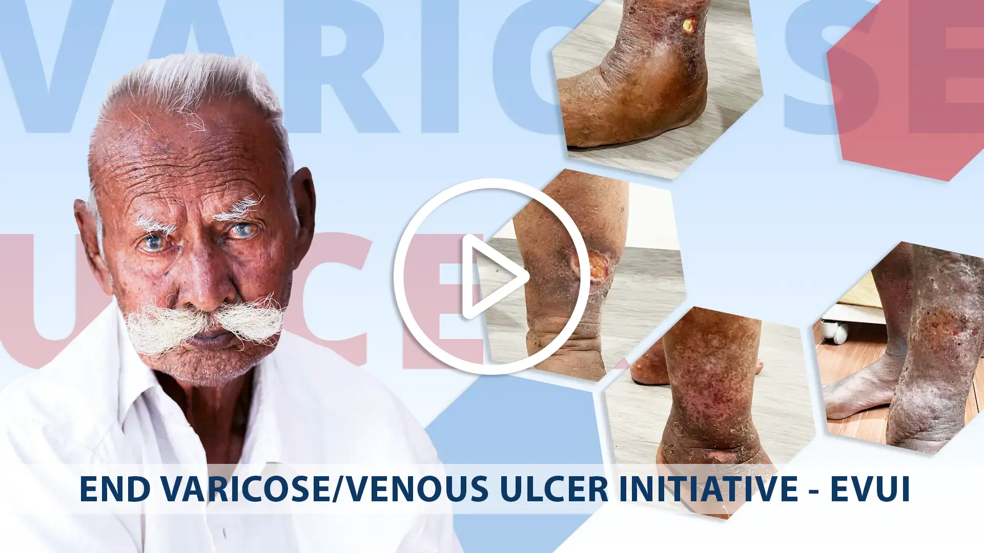 what-is-varicose-ulcer-or-leg-ulcer-video-intro play